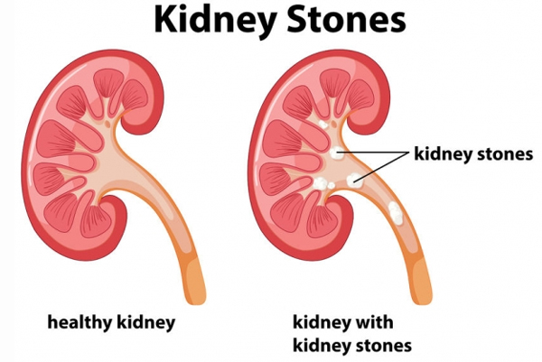 Gall Bladder and Kidney Stone