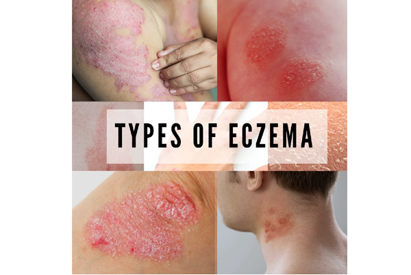 Eczema