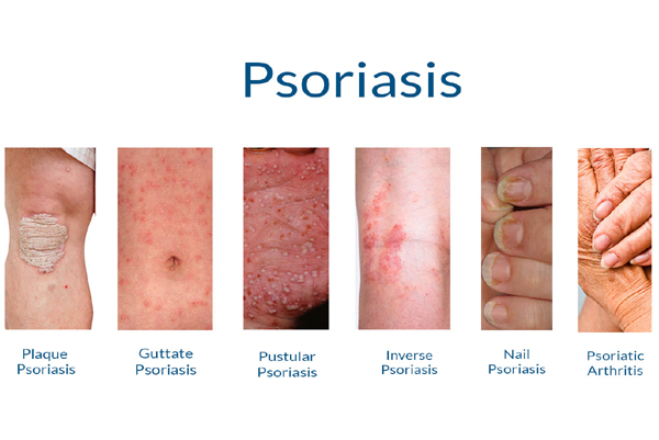 Psoriasis