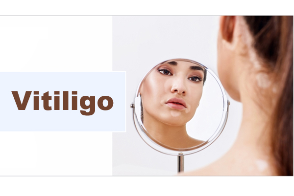 Vitiligo