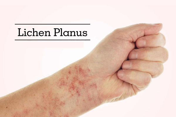 Lichen Planus