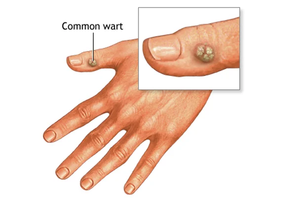 Warts
