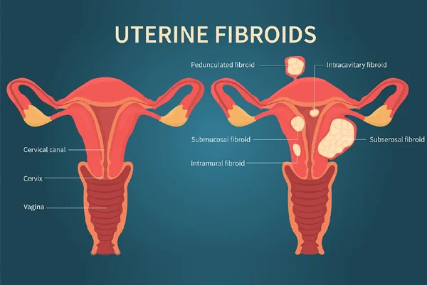 Uterine Fibroid